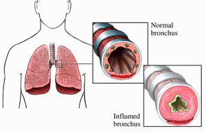 лечение астмы народными средствами