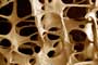 Хрупкие кости – результат остеопороза
